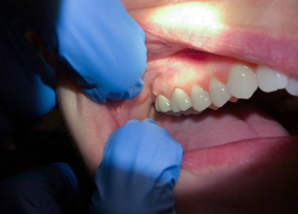 Best Cracked Tooth Emergency Dentist  in Mission, SD